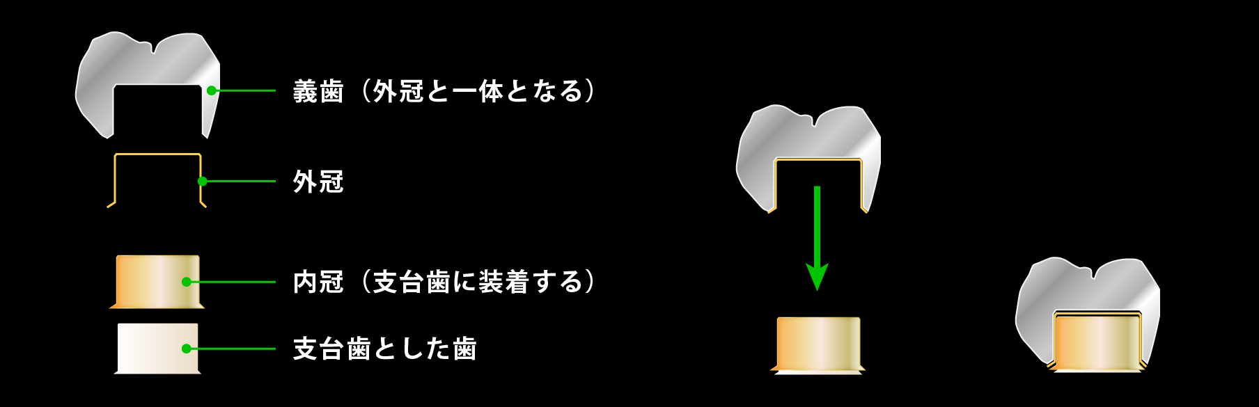 コーヌスクローネとは 世田谷区 コーヌス入れ歯 コーヌスクローネ 入れ歯専門サイト